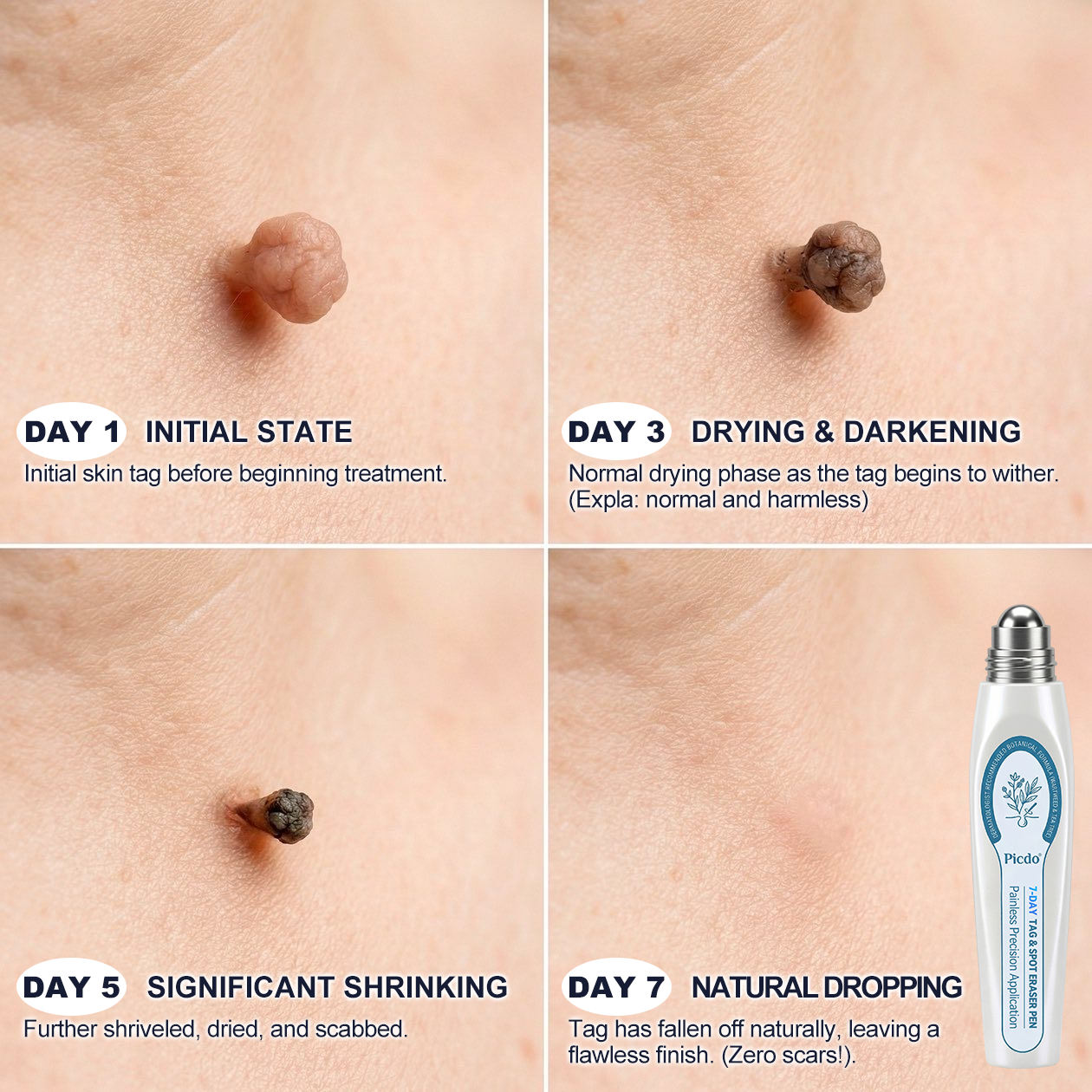 𝐏i𝐜𝐝o® 7-𝐷𝑎𝑦 𝗧𝐚𝐠 & 𝗦𝗽𝐨𝐭 𝐄𝐫𝒂𝒔𝒆𝒓(Zero Pain, Zero 𝐒𝐜𝐚𝒓𝒔 Rollerball) 🌹🌹🌹
