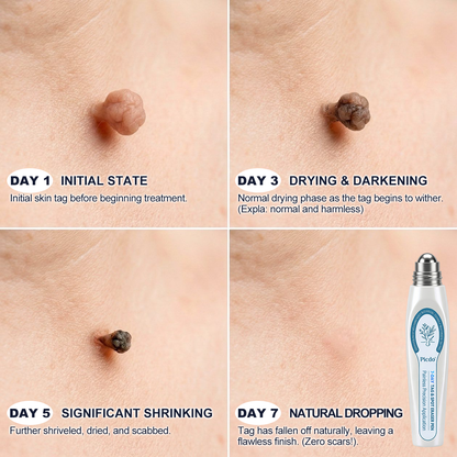 𝐏i𝐜𝐝o® 7-𝐷𝑎𝑦 𝗧𝐚𝐠 & 𝗦𝗽𝐨𝐭 𝐄𝐫𝒂𝒔𝒆𝒓(Zero Pain, Zero 𝐒𝐜𝐚𝒓𝒔 Rollerball) 🌹🌹🌹